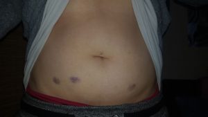 Blaue Flecken durch die Thrombose-Spritzen im Bauch.