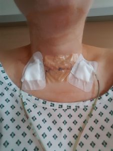 Die Beutel, in welche das Blut läuft, sind am Hemd befestigt, so kann man auch einigermassen entspannt auf die Toilette gehen. Auch nachts hat mich das alles nicht großartig gestört.