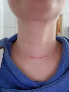 Meine Schilddrüsen-Narbe nach ca. 7 Wochen nach der Schhilddrüsen-OP.