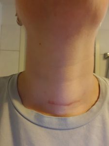 Narbe meiner Schilddrüse, 24 Tage nach der OP.