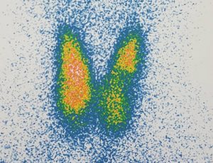 Szintigraphie der Schilddrüse: Hier mit kalten Knoten im linken und rechten Schilddrüsenlappen.