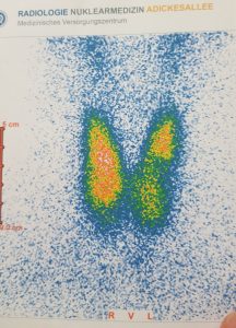 Der Scan meiner Schilddrüsen-Szintigraphie: Rechts und links sieht man, das dort keine Aktivität (= kalter Knoten) mehr ist, das Gewebe also keine radioaktive Substanz aufgenommen hat.