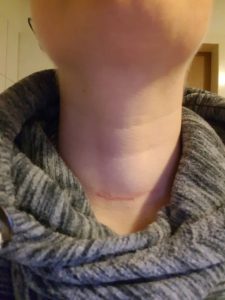 Schilddrüsen-Narbe 11 Wochen nach der OP.