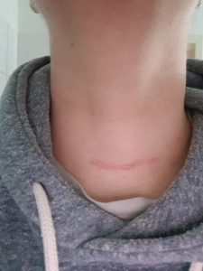 Heilung der Schilddrüsen-Narbe nach 16 Wochen.