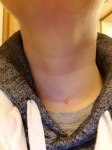 5 Monate nach der OP. Es hat sich ein komischer Pickel gebildet, den ich ausgedrückt habe.