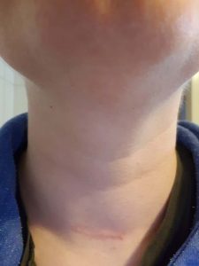 Narbe meiner Schilddrüse 6 Monate nach der OP