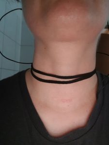 Die Narbe meiner Schilddrüse 10 Monate nach der OP.