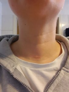 Die Narbe meiner Schilddrüse 8 Monate nach der OP.