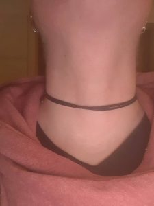 Schilddrüse-Narbe vier Jahre nach der Operation.